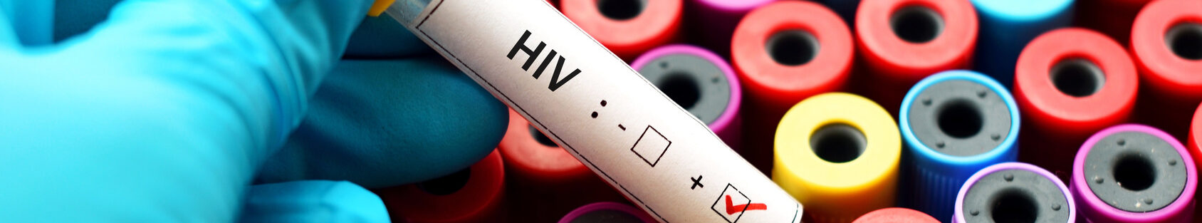 Gesundheit Blutprobe HIV